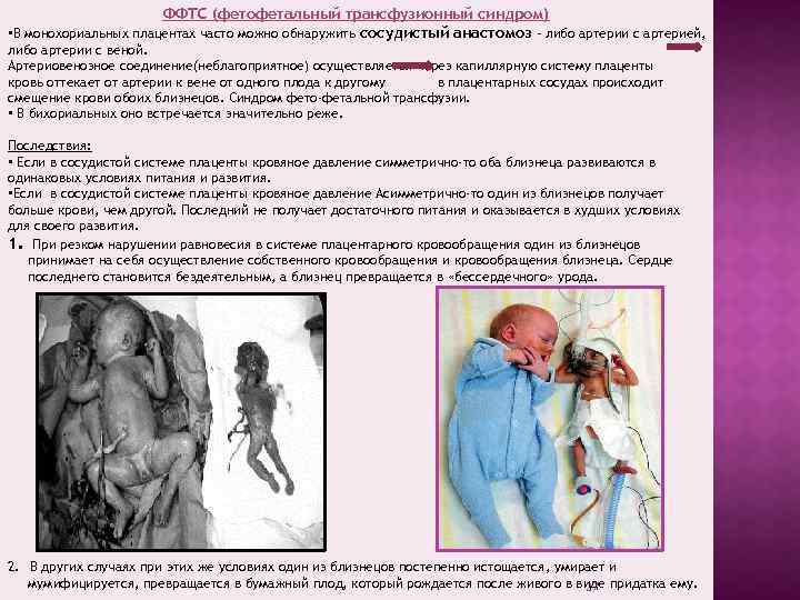 ФФТС (фетофетальный трансфузионный синдром) • В монохориальных плацентах часто можно обнаружить сосудистый анастомоз –