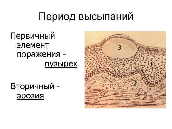 Период высыпаний Первичный элемент поражения - пузырек Вторичный - эрозия 