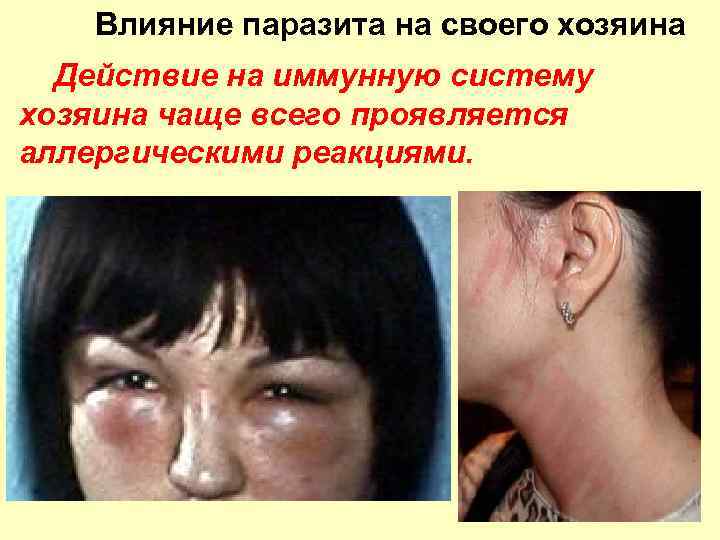 Влияние паразита на своего хозяина Действие на иммунную систему хозяина чаще всего проявляется аллергическими