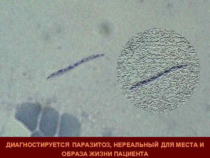 ДИАГНОСТИРУЕТСЯ ПАРАЗИТОЗ, НЕРЕАЛЬНЫЙ ДЛЯ МЕСТА И ОБРАЗА ЖИЗНИ ПАЦИЕНТА 