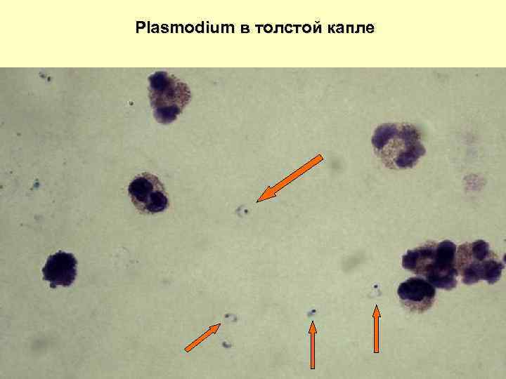 Малярийный плазмодий в толстой капле фото