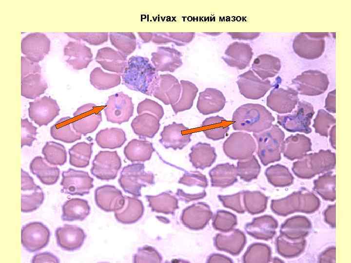 Pl. vivax тонкий мазок 