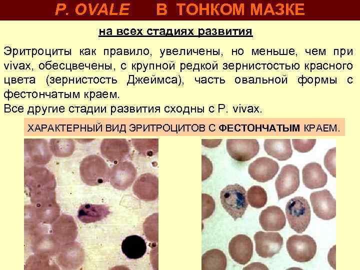 P. OVALE В ТОНКОМ МАЗКЕ на всех стадиях развития Эритроциты как правило, увеличены, но