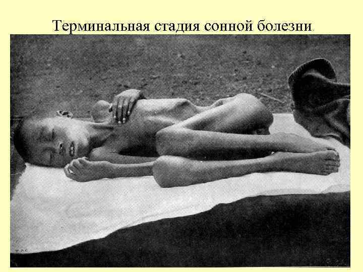 Терминальная стадия сонной болезни . 