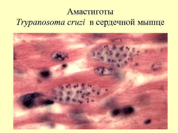 Амастиготы Тrypanosoma cruzi в сердечной мышце 