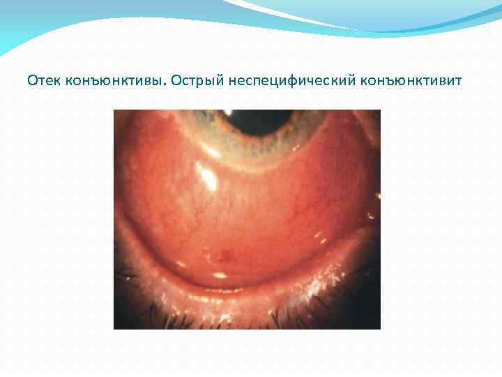 Отек конъюнктивы. Острый неспецифический конъюнктивит 