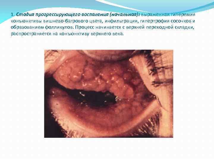 1. Стадия прогрессирующего воспаления (начальная): выраженная гиперемия конъюнктивы вишнево-багрового цвета, инфильтрация, гипертрофия сосочков и