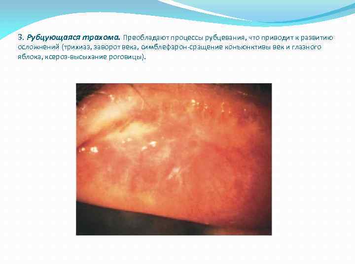 3. Рубцующаяся трахома. Преобладают процессы рубцевания, что приводит к развитию осложнений (трихиаз, заворот века,