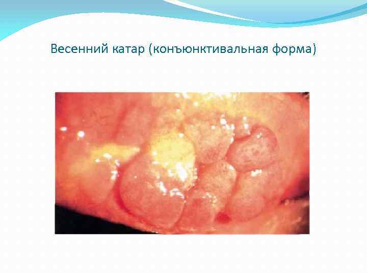 Весенний катар (конъюнктивальная форма) 