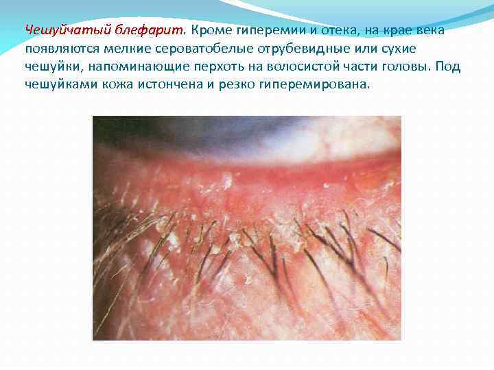 Чешуйчатый блефарит. Кроме гиперемии и отека, на крае века появляются мелкие сероватобелые отрубевидные или