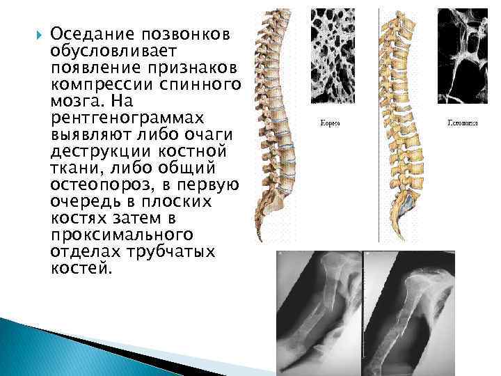  Оседание позвонков обусловливает появление признаков компрессии спинного мозга. На рентгенограммах выявляют либо очаги