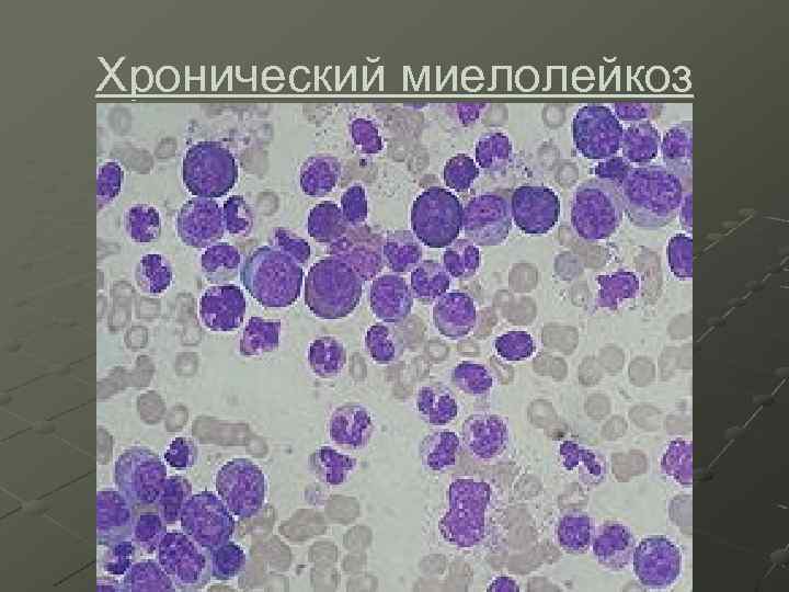 Хронический миелолейкоз 