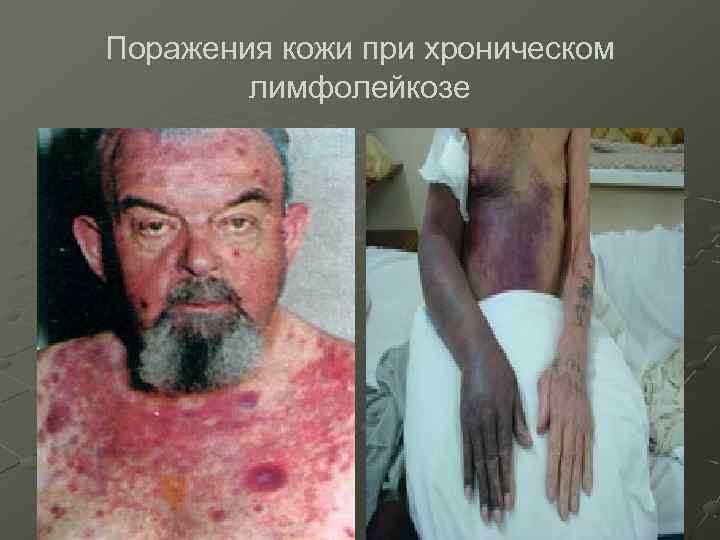 Поражения кожи при хроническом лимфолейкозе 