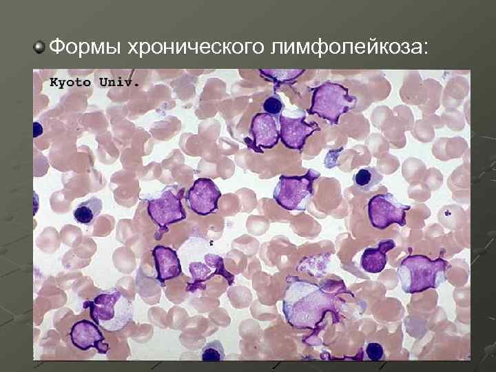 Клетки лимфолейкоза. Тени Боткина Гумпрехта. Клетки Боткина Гумпрехта это. Клетки лейколиза (тени Боткина-Гумпрехта). Хронический миелолейкоз гистология костного мозга.