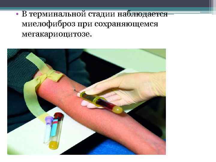 • В терминальной стадии наблюдается миелофиброз при сохраняющемся мегакариоцитозе. 