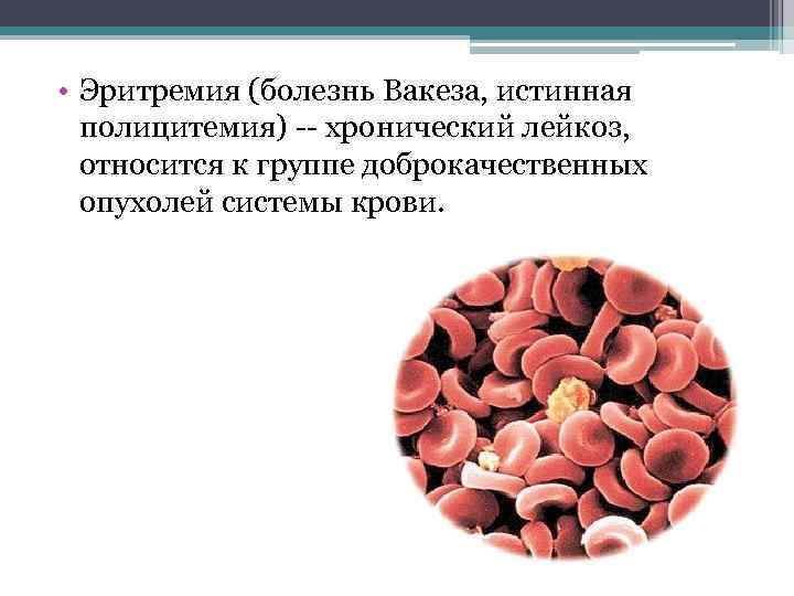  • Эритремия (болезнь Вакеза, истинная полицитемия) -- хронический лейкоз, относится к группе доброкачественных