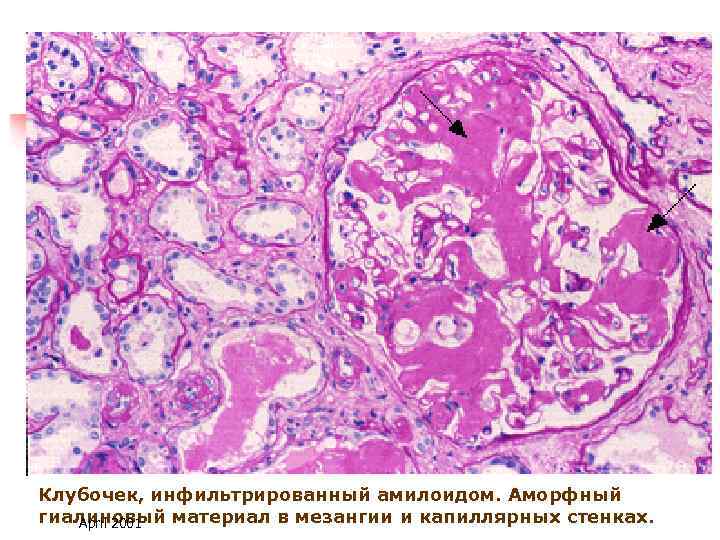 Клубочек, инфильтрированный амилоидом. Аморфный гиалиновый материал в мезангии и капиллярных стенках. April 2001 
