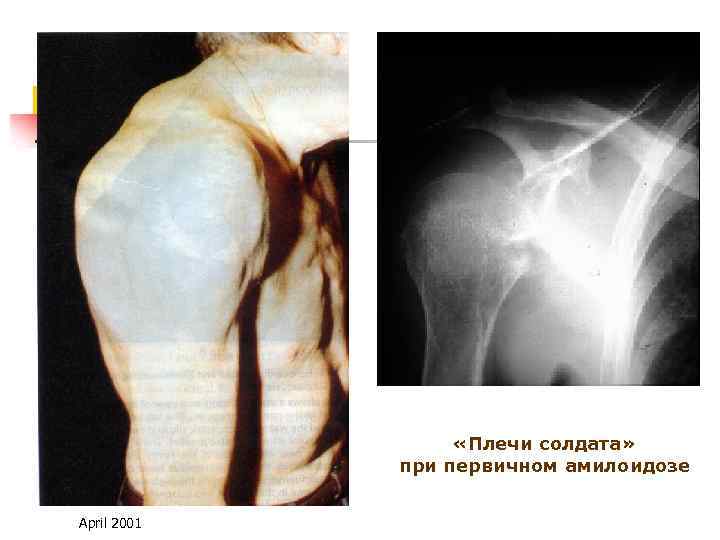  «Плечи солдата» при первичном амилоидозе April 2001 