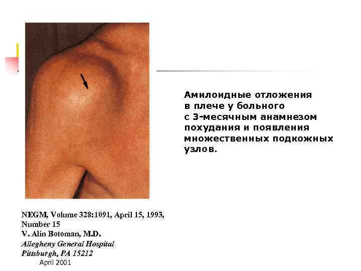 Амилоидные отложения в плече у больного с 3 -месячным анамнезом похудания и появления множественных