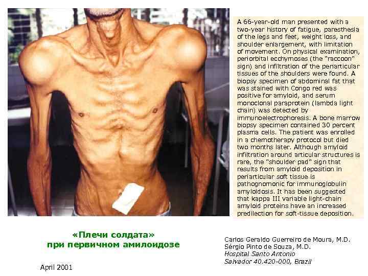 A 66 -year-old man presented with a two-year history of fatigue, paresthesia of the