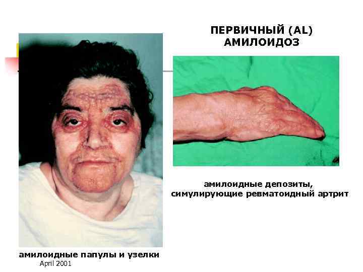 ПЕРВИЧНЫЙ (AL) АМИЛОИДОЗ амилоидные депозиты, симулирующие ревматоидный артрит амилоидные папулы и узелки April 2001