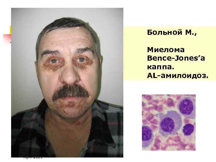 Больной М. , Миелома Bence-Jones’а каппа. AL-амилоидоз. April 2001 