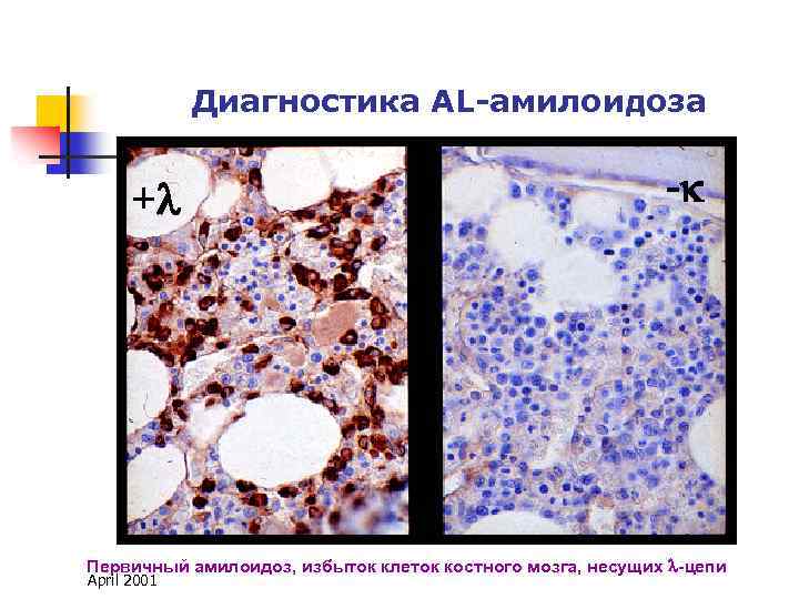Вторичный амилоидоз презентация