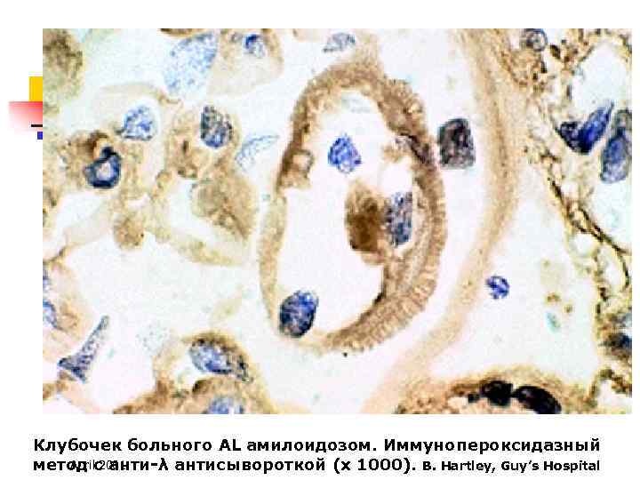 Клубочек больного AL амилоидозом. Иммунопероксидазный April 2001 метод с анти-λ антисывороткой (х 1000). B.