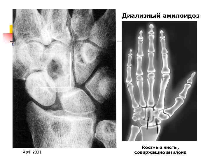 Диализный амилоидоз April 2001 Костные кисты, содержащие амилоид 
