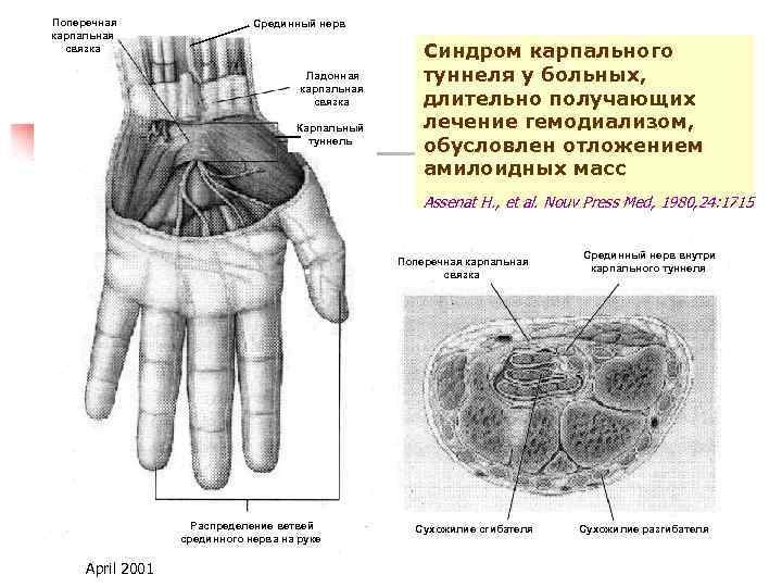 Поперечная карпальная связка Срединный нерв Ладонная карпальная связка Карпальный туннель Синдром карпального туннеля у