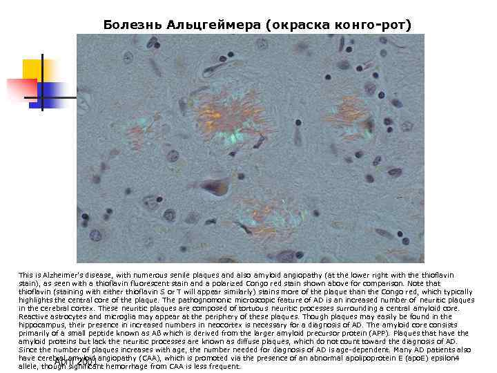 Болезнь Альцгеймера (окраска конго-рот) This is Alzheimer's disease, with numerous senile plaques and also