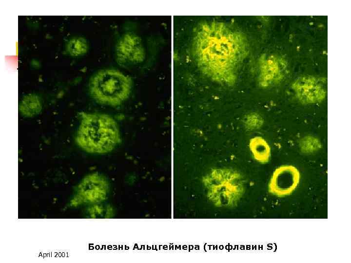 April 2001 Болезнь Альцгеймера (тиофлавин S) 