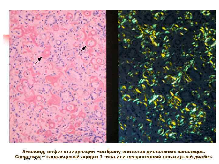 Амилоид, инфильтрирующий мембрану эпителия дистальных канальцев. Следствие – канальцевый ацидоз I типа или нефрогенный