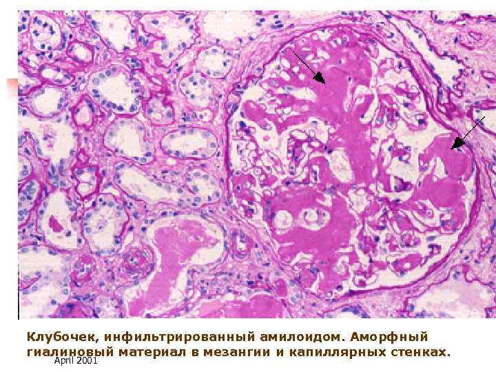 Клубочек, инфильтрированный амилоидом. Аморфный гиалиновый материал в мезангии и капиллярных стенках. April 2001 