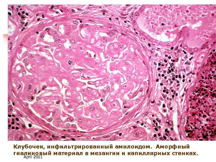 Клубочек, инфильтрированный амилоидом. Аморфный гиалиновый материал в мезангии и капиллярных стенках. April 2001 