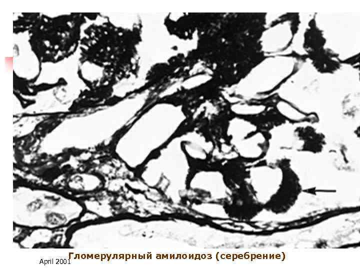 Гломерулярный амилоидоз (серебрение) April 2001 