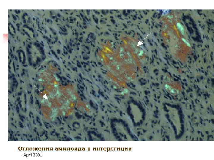 Отложения амилоида в интерстиции April 2001 