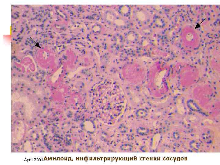 April 2001 Амилоид, инфильтрирующий стенки сосудов 