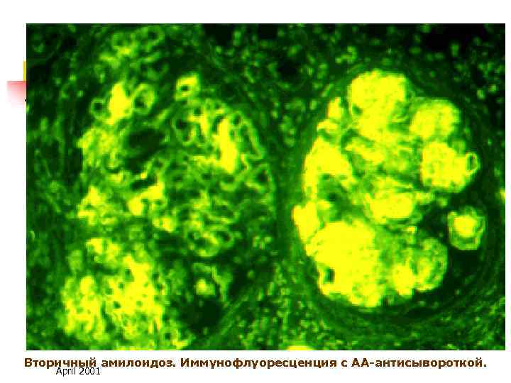Вторичный амилоидоз. Иммунофлуоресценция с АА-антисывороткой. April 2001 