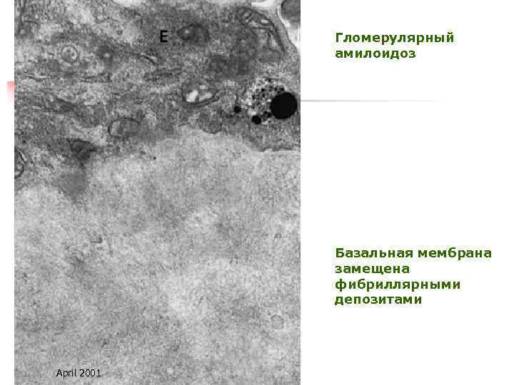 Гломерулярный амилоидоз Базальная мембрана замещена фибриллярными депозитами April 2001 