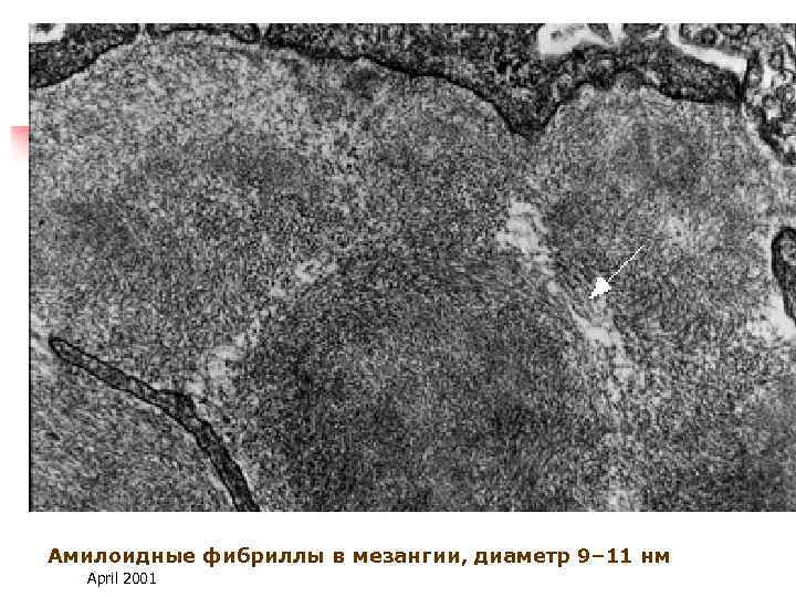 Амилоидные фибриллы в мезангии, диаметр 9– 11 нм April 2001 