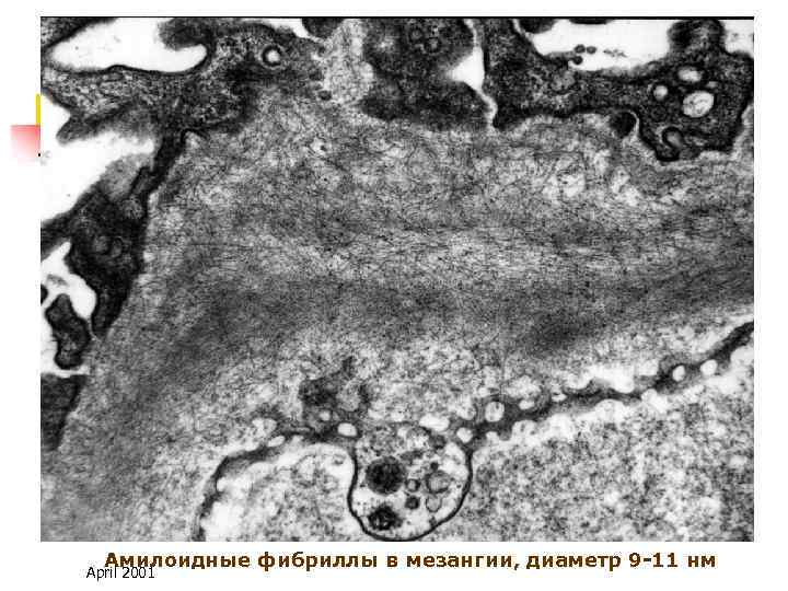 Амилоидные фибриллы в мезангии, диаметр 9 -11 нм April 2001 