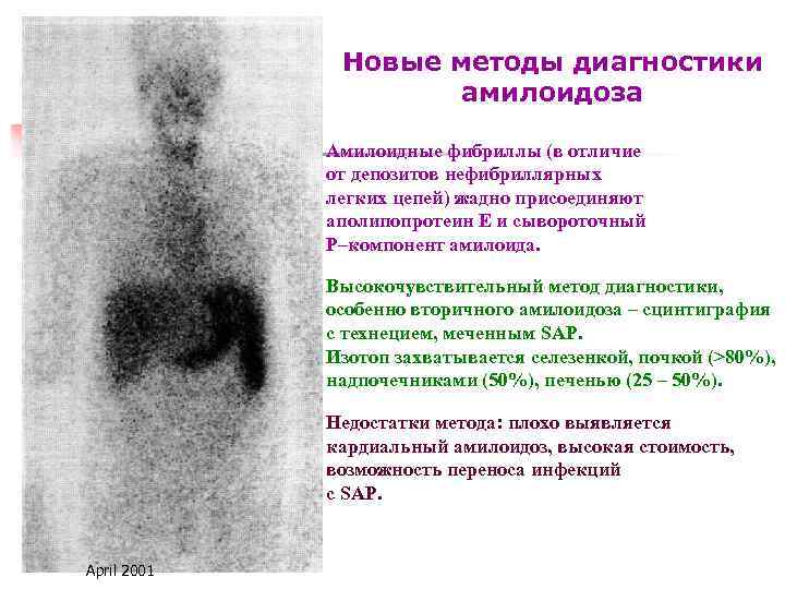 Новые методы диагностики амилоидоза Амилоидные фибриллы (в отличие от депозитов нефибриллярных легких цепей) жадно