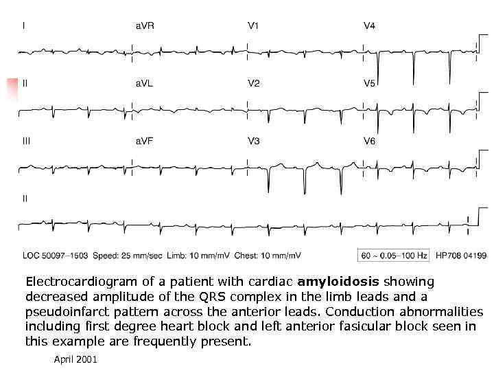 Electrocardiogram of a patient with cardiac amyloidosis showing decreased amplitude of the QRS complex