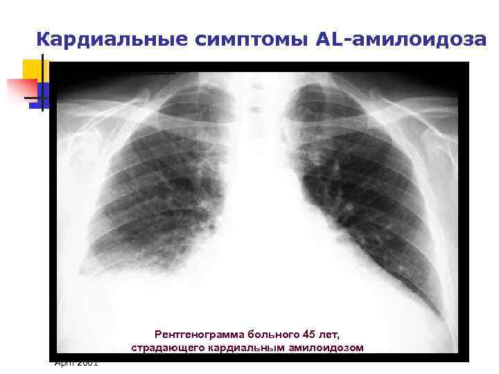 Кардиальные симптомы AL-амилоидоза Рентгенограмма больного 45 лет, страдающего кардиальным амилоидозом April 2001 
