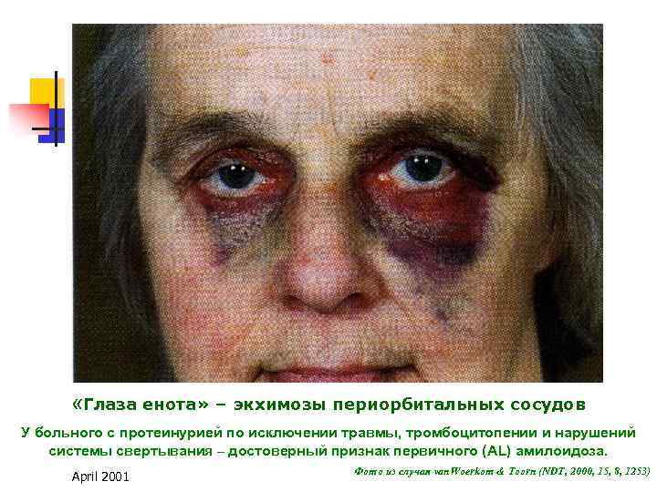  «Глаза енота» – экхимозы периорбитальных сосудов У больного с протеинурией по исключении травмы,