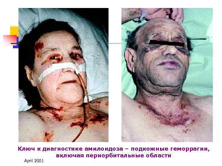 Ключ к диагностике амилоидоза – подкожные геморрагии, включая периорбитальные области April 2001 