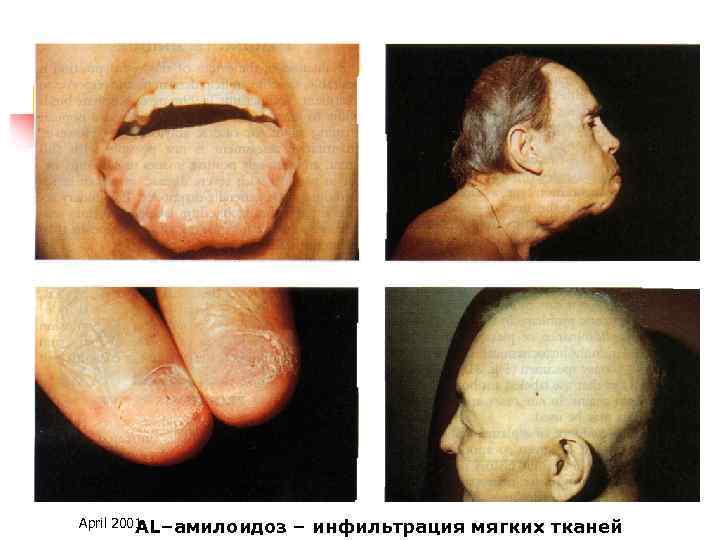 April 2001 AL–амилоидоз – инфильтрация мягких тканей 