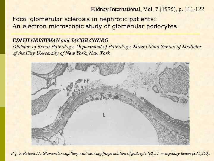 Kidney International, Vol. 7 (1975), p. 111 -122 Focal glomerular sclerosis in nephrotic patients: