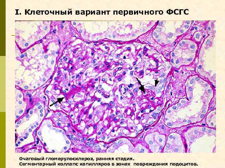 I. Клеточный вариант первичного ФСГС Очаговый гломерулосклероз, ранняя стадия. Сегментарный коллапс капилляров в зонах